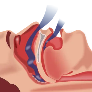 Why is Sleep Apnea?