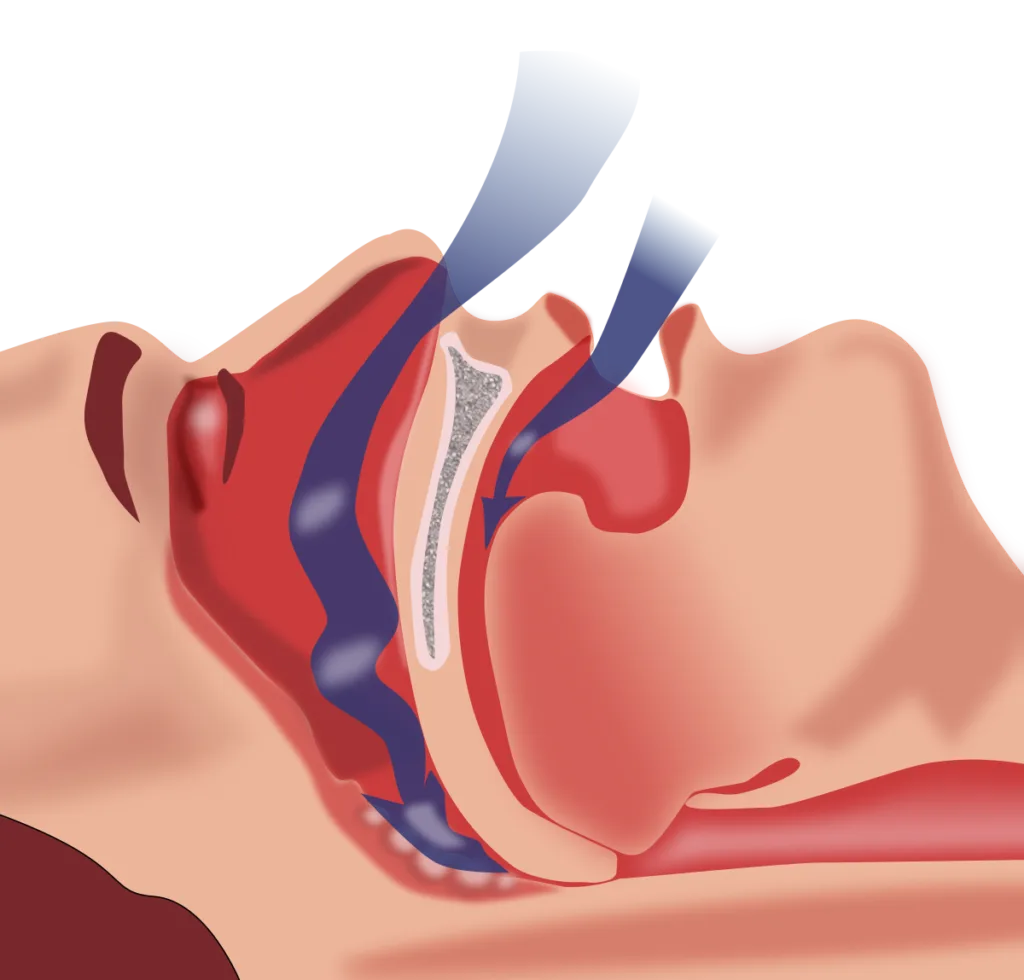 You are currently viewing Why is Sleep Apnea?