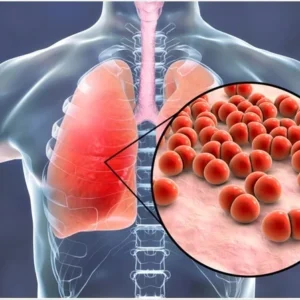 Illustration of human lungs showing infection with bacteria highlighted