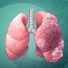 Why do patients with chronic obstructive pulmonary disease (COPD) need oxygen?
